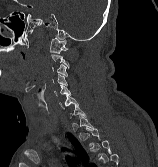 Cervical spine trauma with tear drop fracture and perched facet joint (Radiopaedia 53989-60127 Sagittal bone window 36).jpg