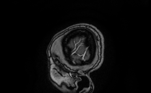 Cervical spondylodiscitis and calvarial hemangioma (Radiopaedia 64317-73103 Sagittal T1 C+ 3).jpg