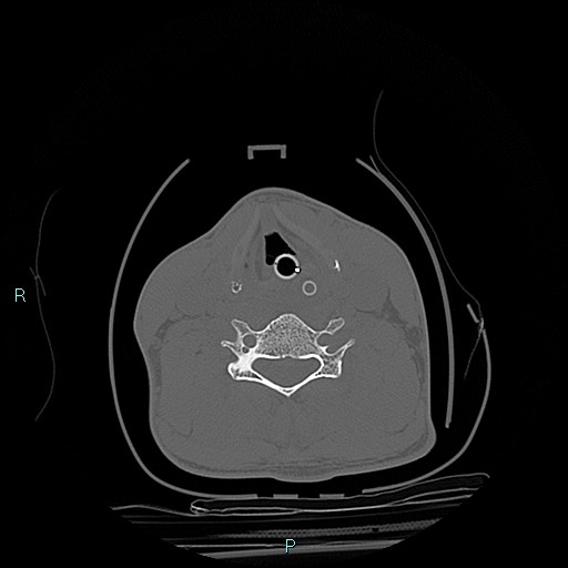 File:Cervical vertebral burst fracture (Radiopaedia 37420-39258 Axial bone window 7).jpg