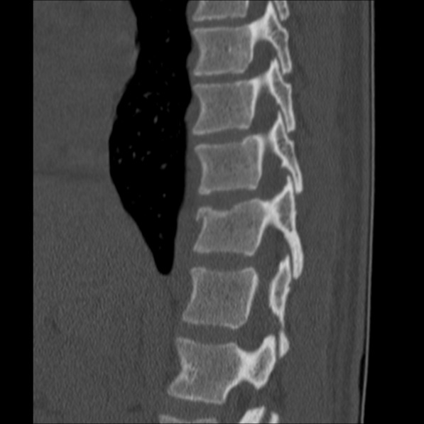 Chance fracture (Radiopaedia 36521-38081 Sagittal bone window 21).jpg