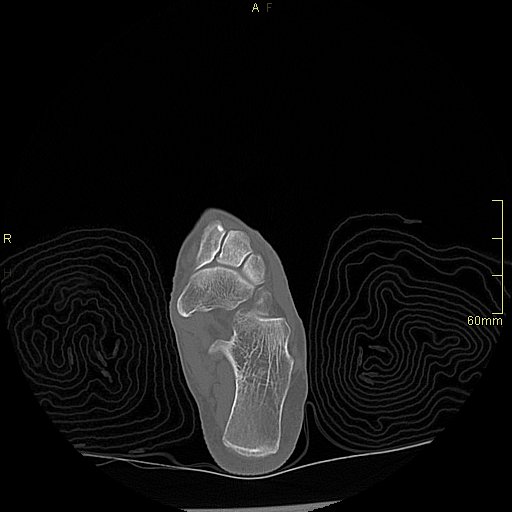 File:Chaput tubercle fracture (Radiopaedia 80319-93956 Axial non-contrast 30).jpg