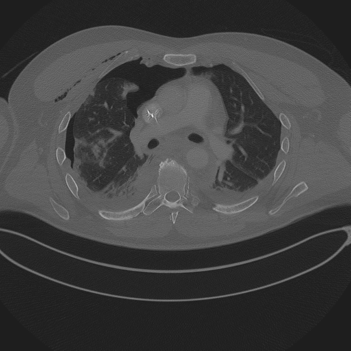 Chest multitrauma - aortic injury (Radiopaedia 34708-36147 Axial bone window 133).png