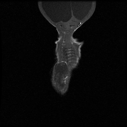 File:Chiari II malformation with spinal meningomyelocele (Radiopaedia 23550-23652 Coronal T1 9).jpg