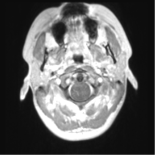 File:Chiari I malformation and obstructive hydrocephalus (Radiopaedia 41185-43978 Axial T1 C+ 4).png