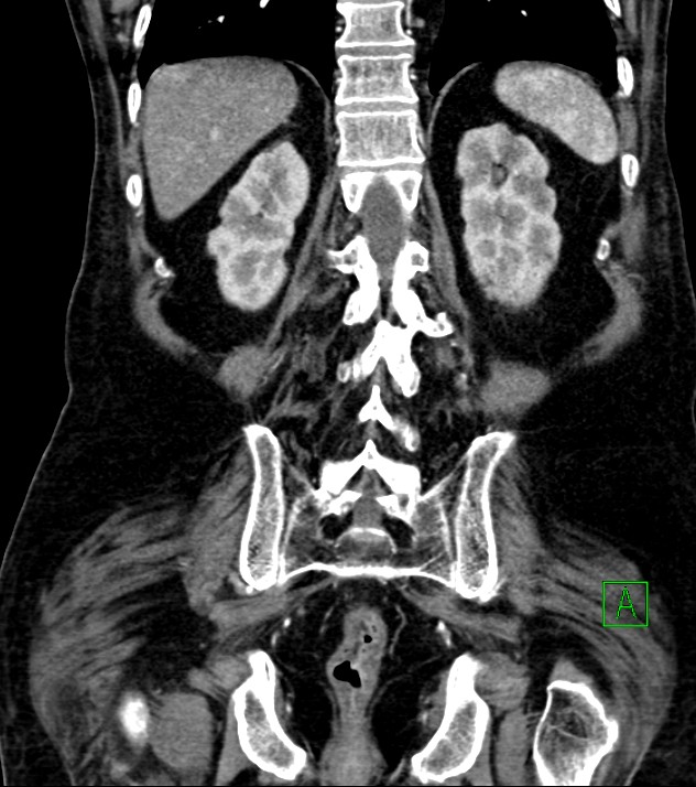 Cholangiocarcinoma with cerebral metastases (Radiopaedia 83519-98629 E 66).jpg