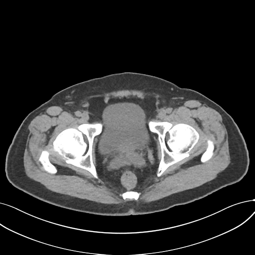 File:Cholecystitis with focal perforation and hepatic abscess (Radiopaedia 37189-38945 Axial non-contrast 81).png