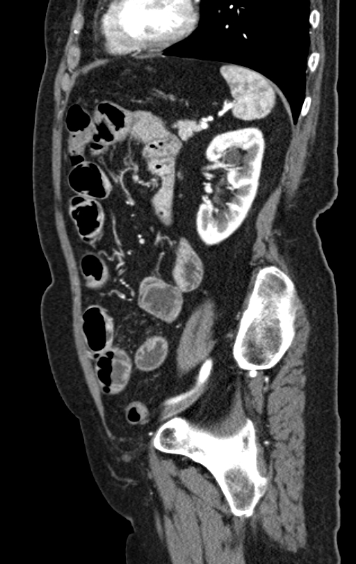 Cholecystoduodenal fistula due to calculous cholecystitis with gallstone migration (Radiopaedia 86875-103077 C 19).jpg