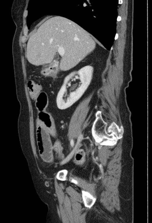 Cholecystoduodenal fistula due to calculous cholecystitis with gallstone migration (Radiopaedia 86875-103077 F 40).jpg