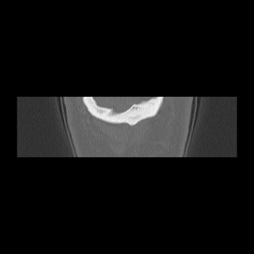 Cholesteatoma (Radiopaedia 84946-100455 Coronal bone window 166).jpg