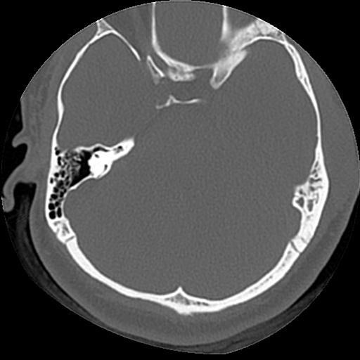 Cholesteatoma (Radiopaedia 84960-100474 Axial bone window 32).jpg