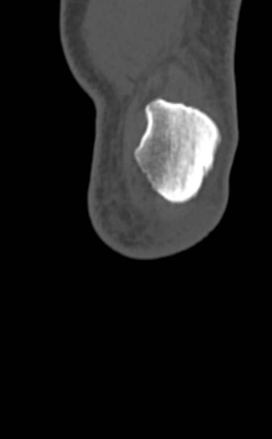 Chondrocalcinosis (Radiopaedia 82862-97173 Coronal bone window 6).jpg