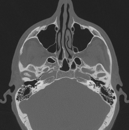 Chondrosarcoma (clivus) (Radiopaedia 46895-51425 Axial bone window 50).png