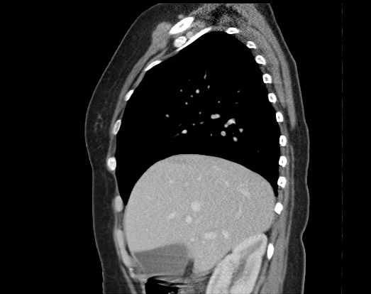 Chondrosarcoma - chest wall (Radiopaedia 65192-74199 B 42).jpg