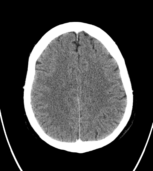 File:Chondrosarcoma of skull base- grade II (Radiopaedia 40948-43653 Axial Contrast 21).png