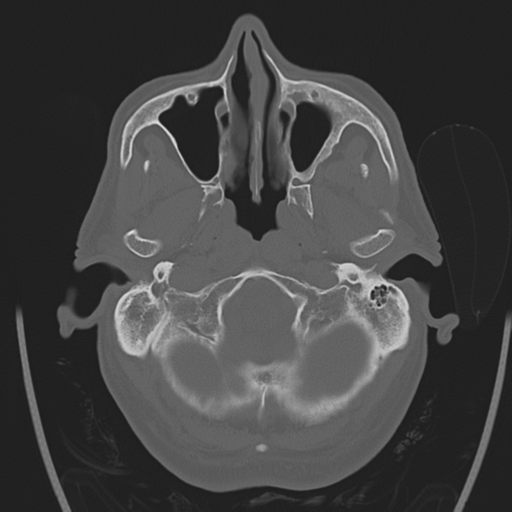 File:Chondrosarcoma of skull base- grade II (Radiopaedia 40948-43653 Axial bone window 4).png