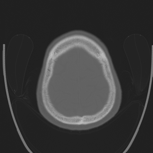 Chondrosarcoma of skull base- grade II (Radiopaedia 40948-43653 Axial bone window 43).png