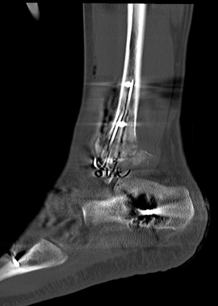 Chopart fracture (Radiopaedia 35347-36861 Sagittal bone window 55).jpg