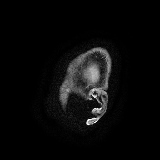 Chordoid glioma of third ventricle (Radiopaedia 91612-109340 F 203).jpg