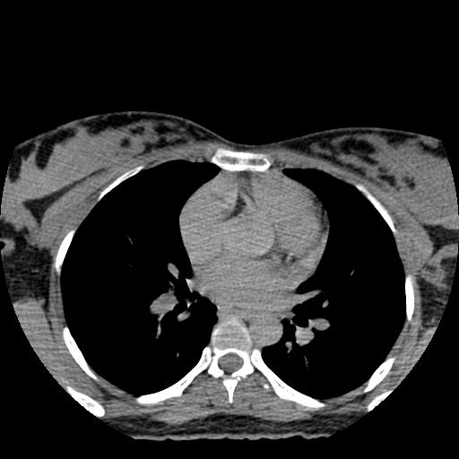 File:Choriocarcinoma of ovary with cerebral and pulmonary metastases (Radiopaedia 25983-26119 Axial non-contrast 140).jpg