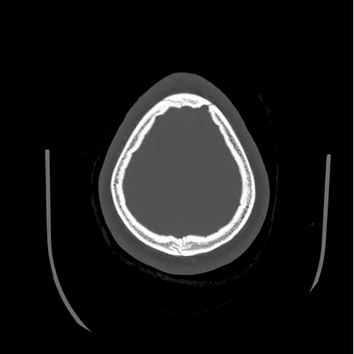 Choroid plexus papilloma extending into the cerebellopontine angle cistern (Radiopaedia 85941-101833 Axial bone window 82).png
