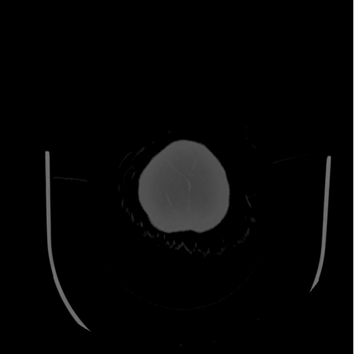 Choroid plexus papilloma extending into the cerebellopontine angle cistern (Radiopaedia 85941-101833 Axial bone window 93).png