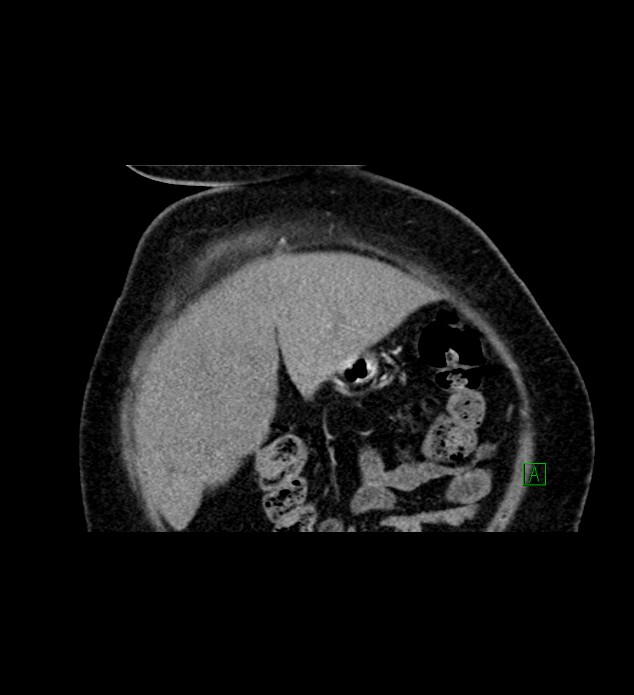 Chromophobe renal cell carcinoma (Radiopaedia 84239-99519 C 16).jpg