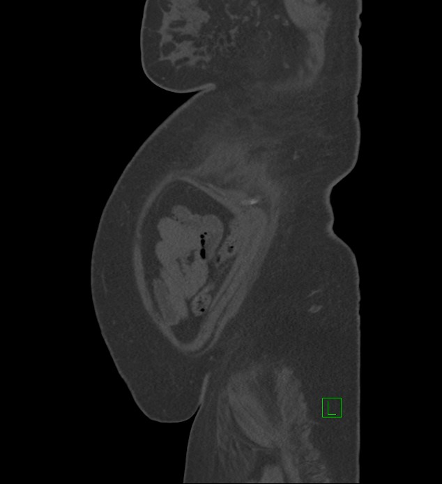 Chromophobe renal cell carcinoma (Radiopaedia 84239-99519 Sagittal bone window 5).jpg