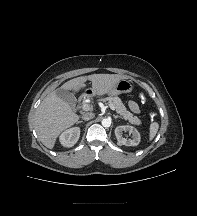 Chromophobe renal cell carcinoma (Radiopaedia 84337-99644 B 29).jpg