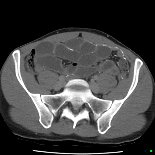 File:Chronic barium peritonitis and small bowel obstruction (Radiopaedia 29151-29548 D 11).jpg