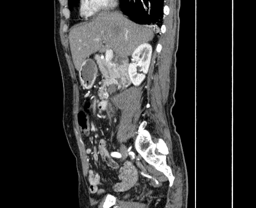 File:Chronic contained rupture of abdominal aortic aneurysm with extensive erosion of the vertebral bodies (Radiopaedia 55450-61901 B 9).jpg