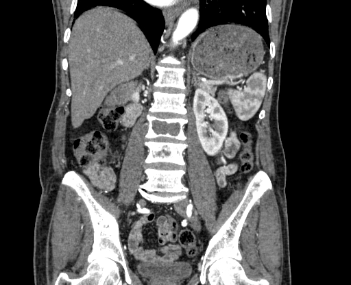 Chronic contained rupture of abdominal aortic aneurysm with extensive erosion of the vertebral bodies (Radiopaedia 55450-61901 D 47).jpg