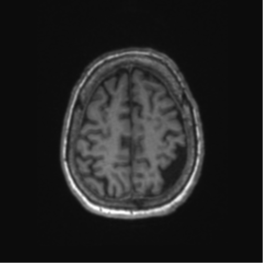 File:Chronic hypertensive encephalopathy (Radiopaedia 72844-83495 Axial T1 17).png
