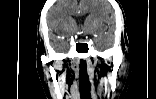 Chronic invasive fungal sinusitis (Radiopaedia 91563-109286 D 110).jpg