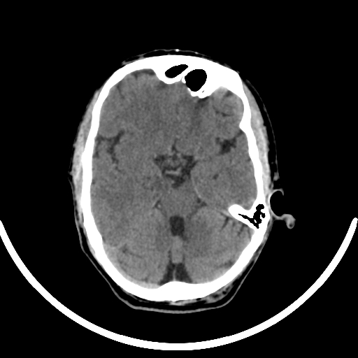 File:Chronic invasive fungal sinusitis with intraorbital and intracranial extension (Radiopaedia 56387-63046 Axial non-contrast 163).jpg