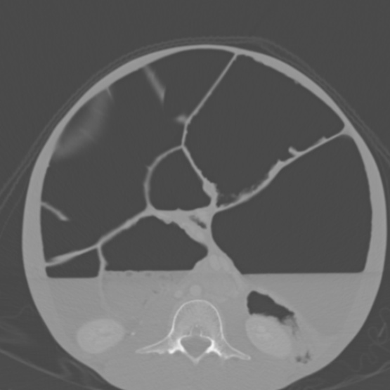 Chronic large bowel pseudo-obstruction (Radiopaedia 43181-46492 Axial bone window 99).jpg