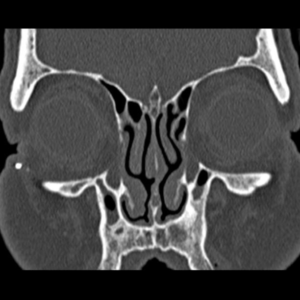 Chronic maxillary sinusitis (Radiopaedia 27879-28116 Coronal bone window 16).jpg