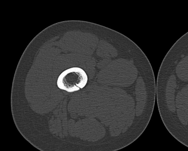 File:Chronic ostemyelitis of the femur with long sinus tract (Radiopaedia 74947-85982 Axial bone window 59).jpg