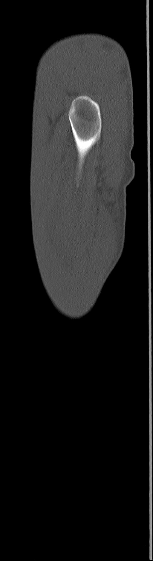 Chronic osteomyelitis (with sequestrum) (Radiopaedia 74813-85822 C 103).jpg
