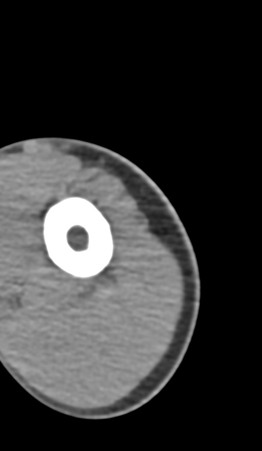 Chronic osteomyelitis of the distal humerus (Radiopaedia 78351-90971 Axial non-contrast 21).jpg