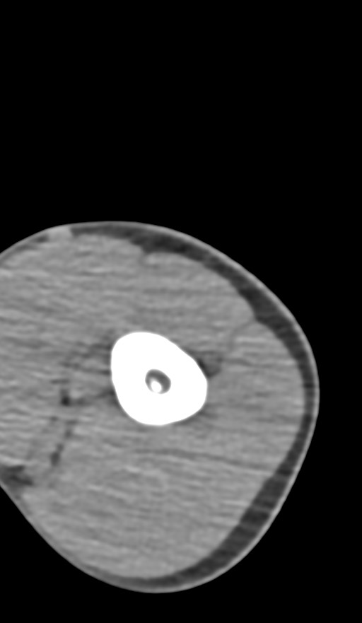 Chronic osteomyelitis of the distal humerus (Radiopaedia 78351-90971 Axial non-contrast 39).jpg