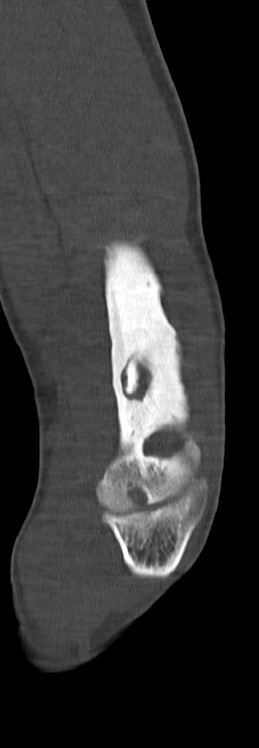 Chronic osteomyelitis of the distal humerus (Radiopaedia 78351-90971 Sagittal bone window 54).jpg