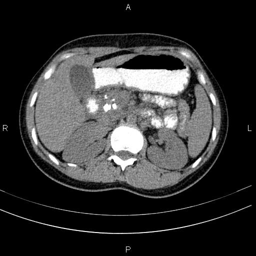 Chronic pancreatitis (Radiopaedia 64576-73450 Axial non-contrast 51).jpg