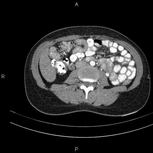 Chronic pancreatitis (Radiopaedia 64576-73450 B 88).jpg