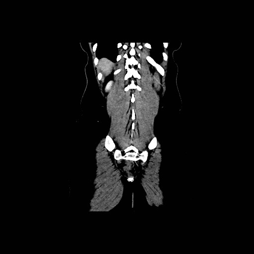 Chronic portal venous thrombosis with cavernous transformation (Radiopaedia 73618-84398 B 89).jpg