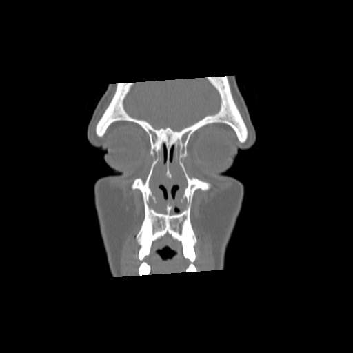 File:Chronic sinusitis with intra-sinus calcification (Radiopaedia 63919-72668 Coronal bone window 6).jpg