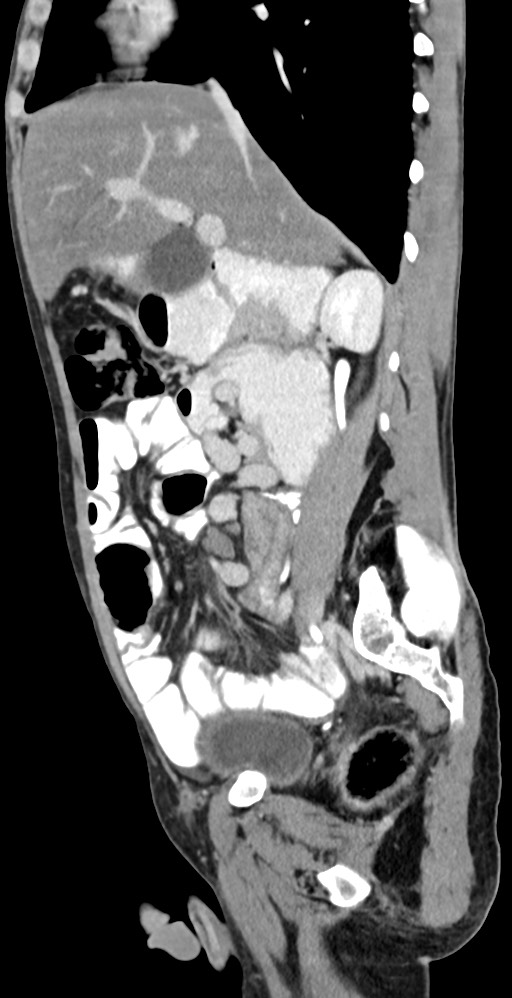 Chronic small bowel volvulus (Radiopaedia 75224-86322 C 92).jpg