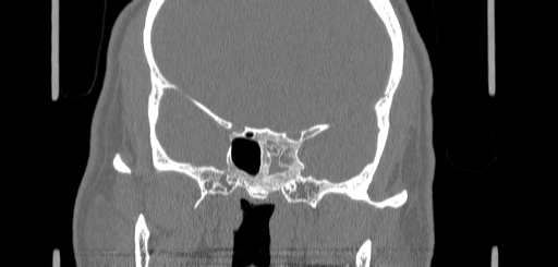 Chronic sphenoidal sinusitis (Radiopaedia 62030-70122 Coronal bone window 116).jpg
