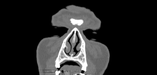Chronic sphenoidal sinusitis (Radiopaedia 62030-70122 Coronal bone window 5).jpg