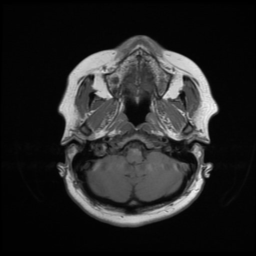 File:Chronic submandibular sialadenitis (Radiopaedia 61852-69885 Axial T1 4).jpg