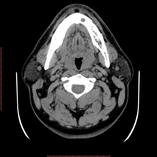 Chronic submandibular sialolithiasis (Radiopaedia 69817-79814 Axial non-contrast 92).jpg